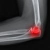 upload/articles/thumbs/210113095140Osteoarthritis elbow.jpg
